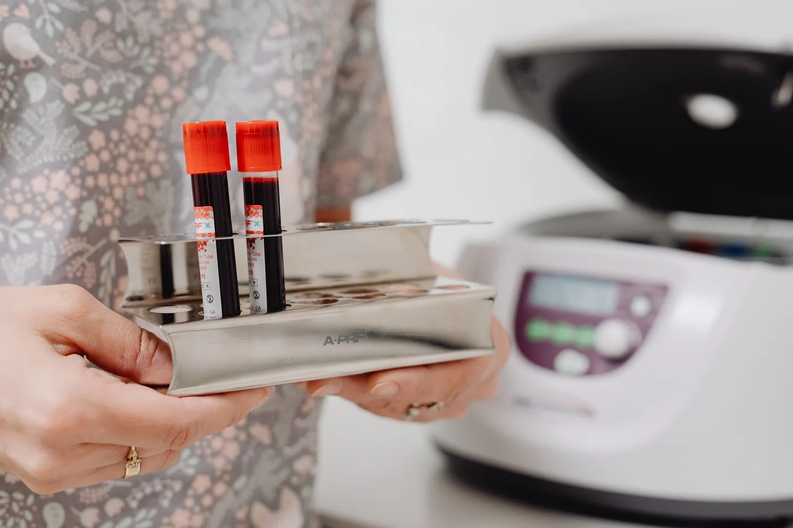 Close-up of blood vials in a laboratory setting, ready for testing. Stock photo illustrating Vijaya Diagnostic Centre's earning call story.