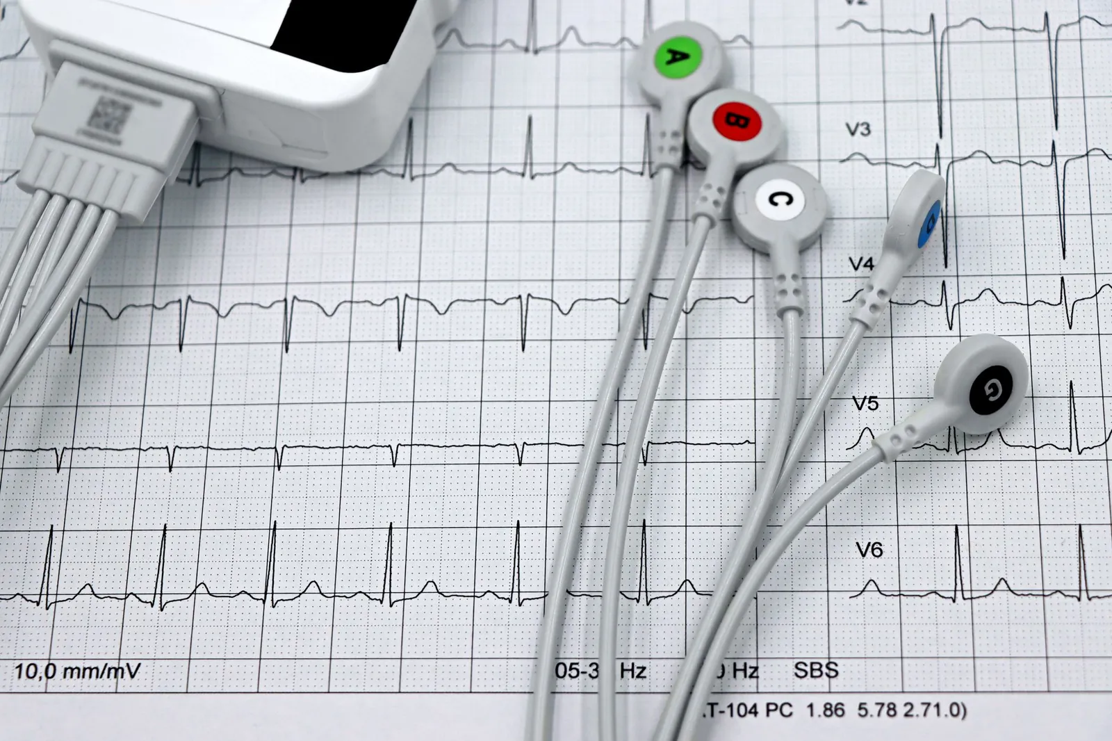 Close-up of ECG monitor leads on a printed cardiogram, showcasing heart health diagnostics. Stock photo illustrating Sun Pharmaceutical Industries' partnership story.